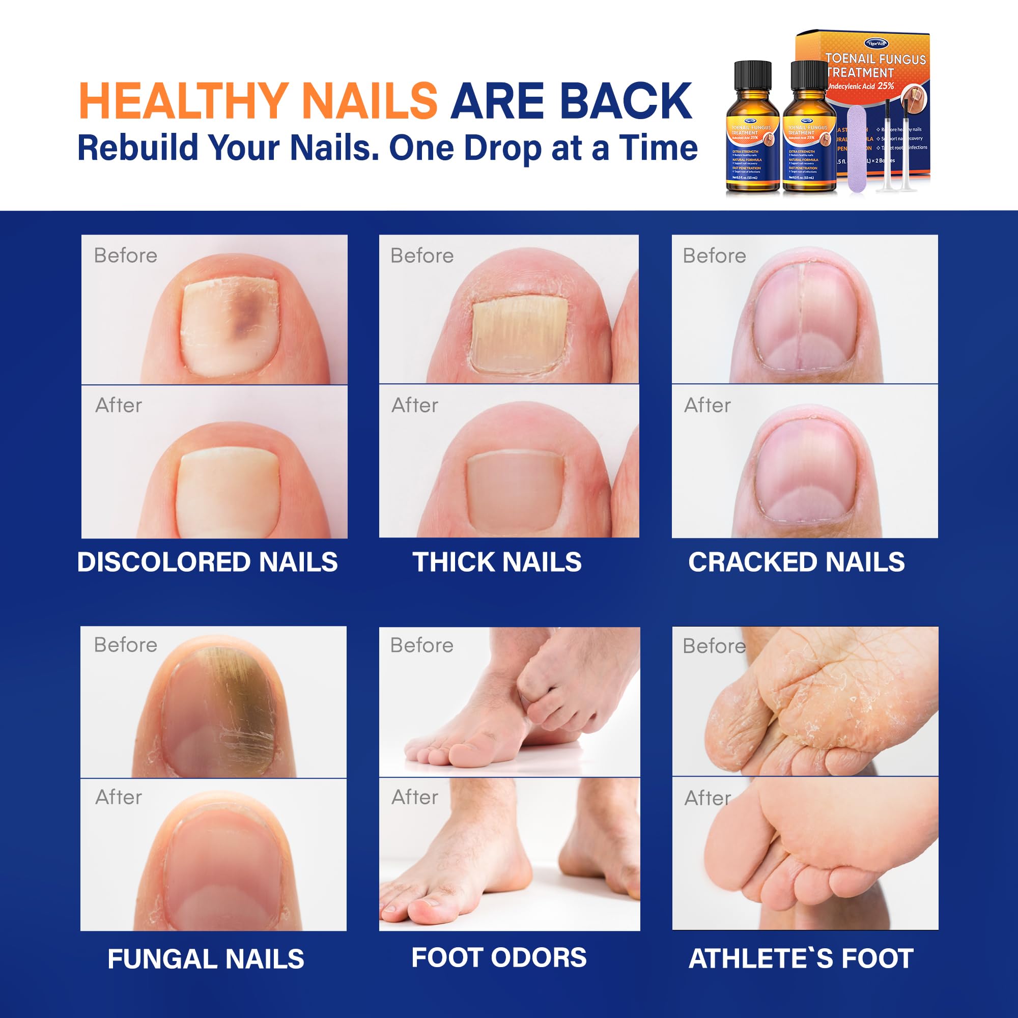 Toenail Fungus Treatment with 25% Undecylenic Acid: Toenail Fungus Treatment Extra Strength for Thick, Yellow and Damaged Nails - Safe and Gentle for Nails Care