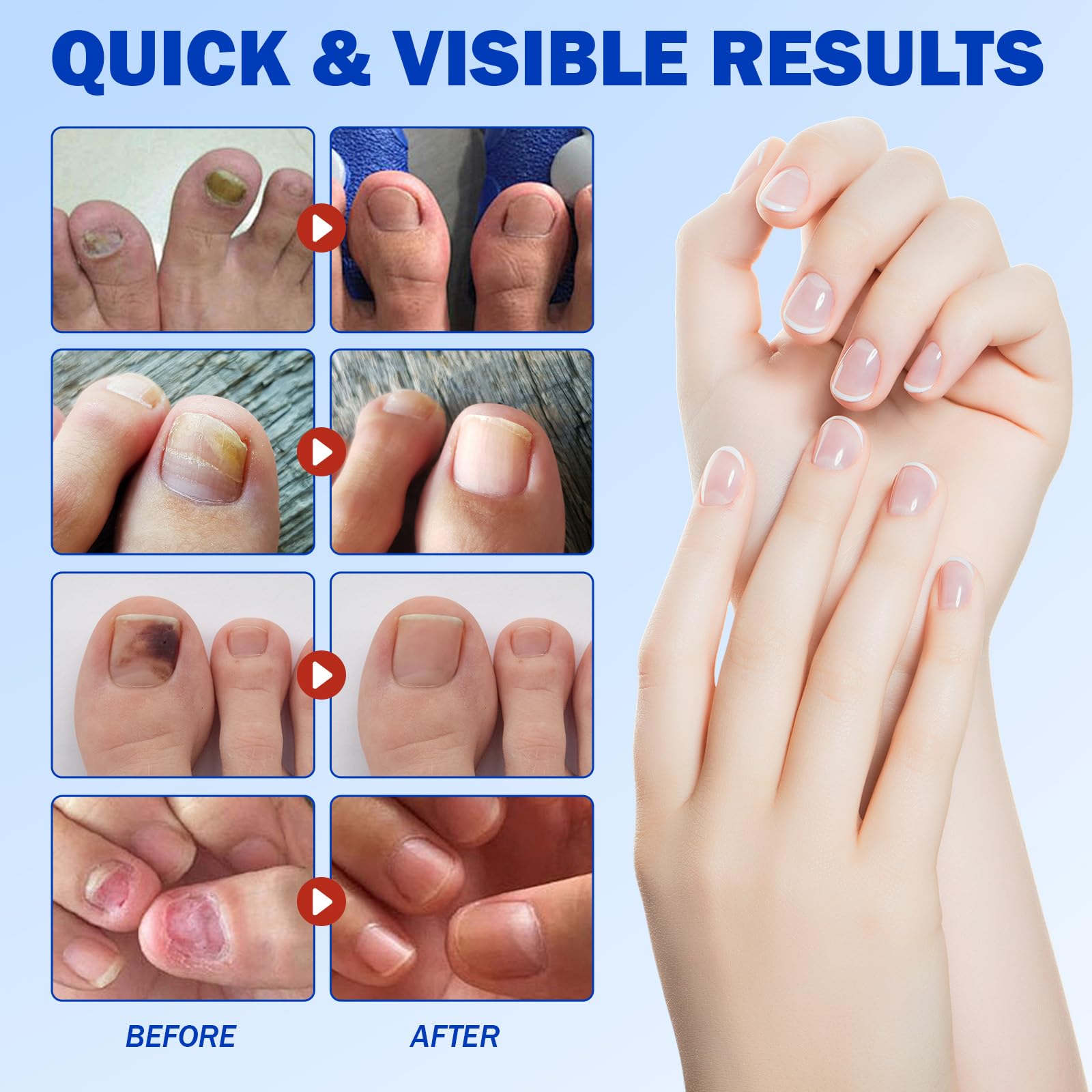 Nail Patches 21 PCS Toenail Treatment Extra Strength 8-Hour Overnight Nail Fast Acting Repair Effortless Hydrogel Nail Care and Repair for Damaged Nails Overnight Renewal for Men and Women